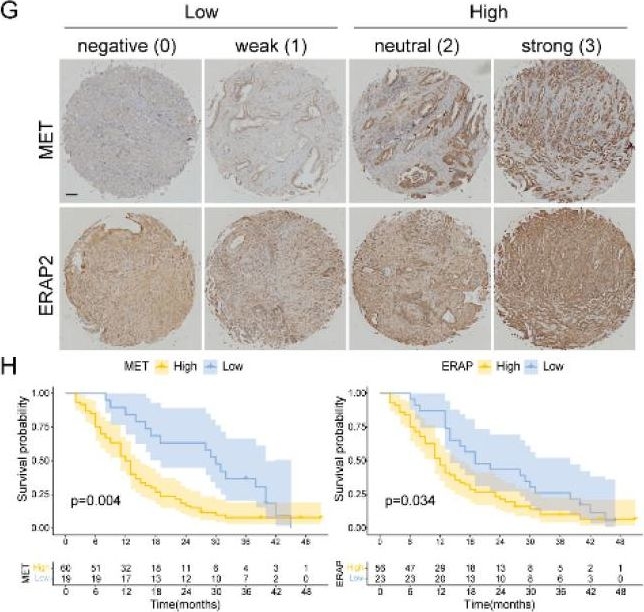 Fig.8.G showing Immunohistochemistry in a Homo sapiens (Human) sample from the publication: Multiple Perspectives Reveal the Role of DNA Damage Repair Genes in the Molecular Classification and Prognosis of Pancreatic Adenocarcinoma.