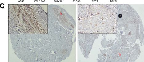 Fig.7.C showing Immunohistochemistry in a Homo sapiens (Human) sample from the publication: Integrated Analysis Identifies an Anoikis-Related Gene Signature for Predicting Prognosis in Patients With Triple-Negative Breast Cancer.