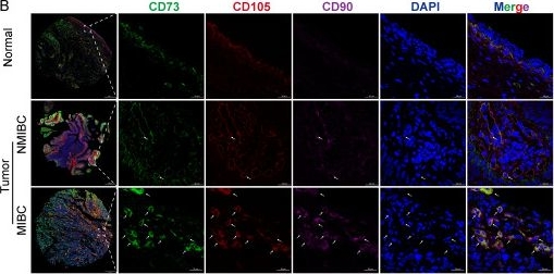 Fig.1.B showing Immunohistochemistry-immunofluorescence in a Homo sapiens (Human) sample from the publication: TIMP1 Derived from Mesenchymal Stem Cells Promotes Bladder Cancer Progression by Regulating the Formation of VDIMs through the RAP1 Pathway.