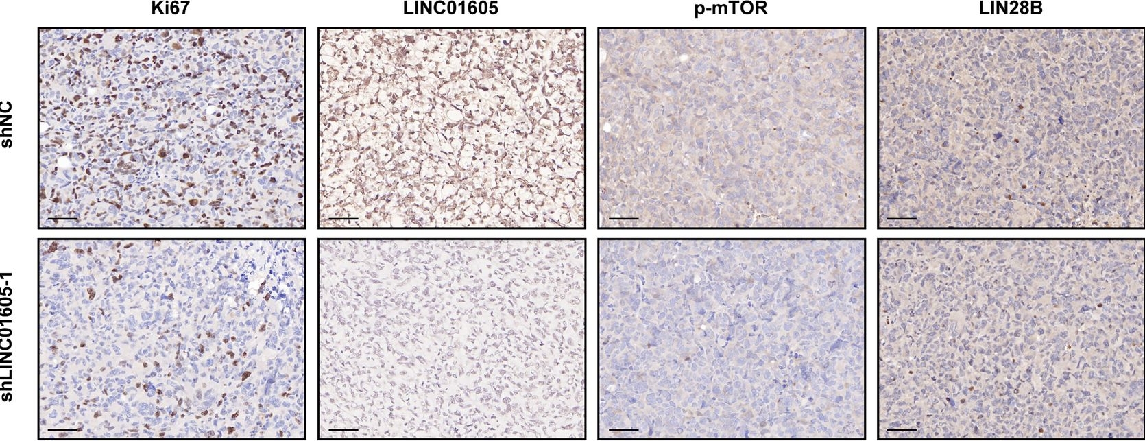 Fig.6.D showing Immunohistochemistry in a Homo sapiens (Human) sample from the publication: The lncRNA LINC01605 promotes the progression of pancreatic ductal adenocarcinoma by activating the mTOR signaling pathway.