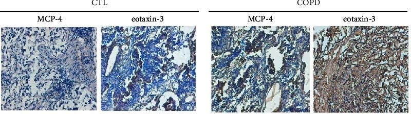 Fig.1.A showing Immunohistochemistry in a Homo sapiens (Human) sample from the publication: MCP-4 and Eotaxin-3 Are Novel Biomarkers for Chronic Obstructive Pulmonary Disease.