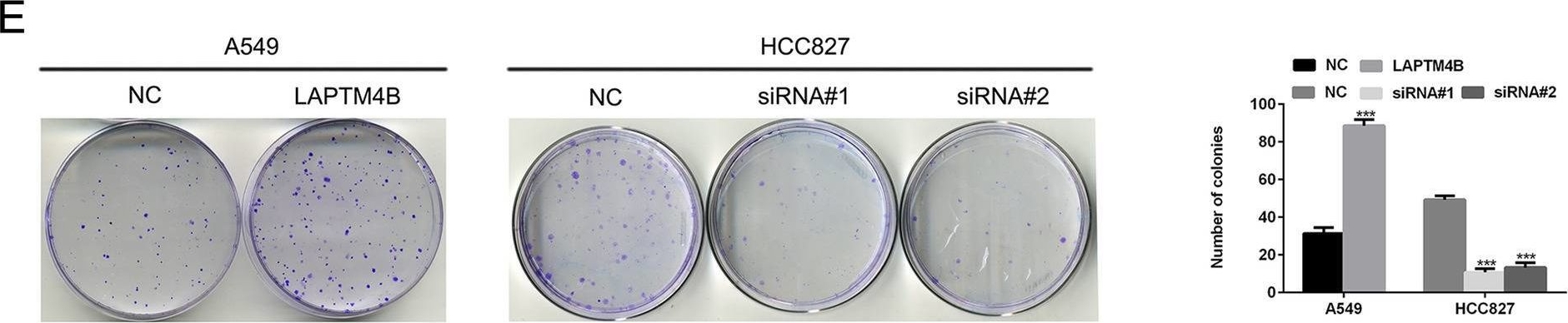 Fig.3.E showing Immunohistochemistry in a Homo sapiens (Human) sample from the publication: LAPTM4B is a novel diagnostic and prognostic marker for lung adenocarcinoma and associated with mutant EGFR.