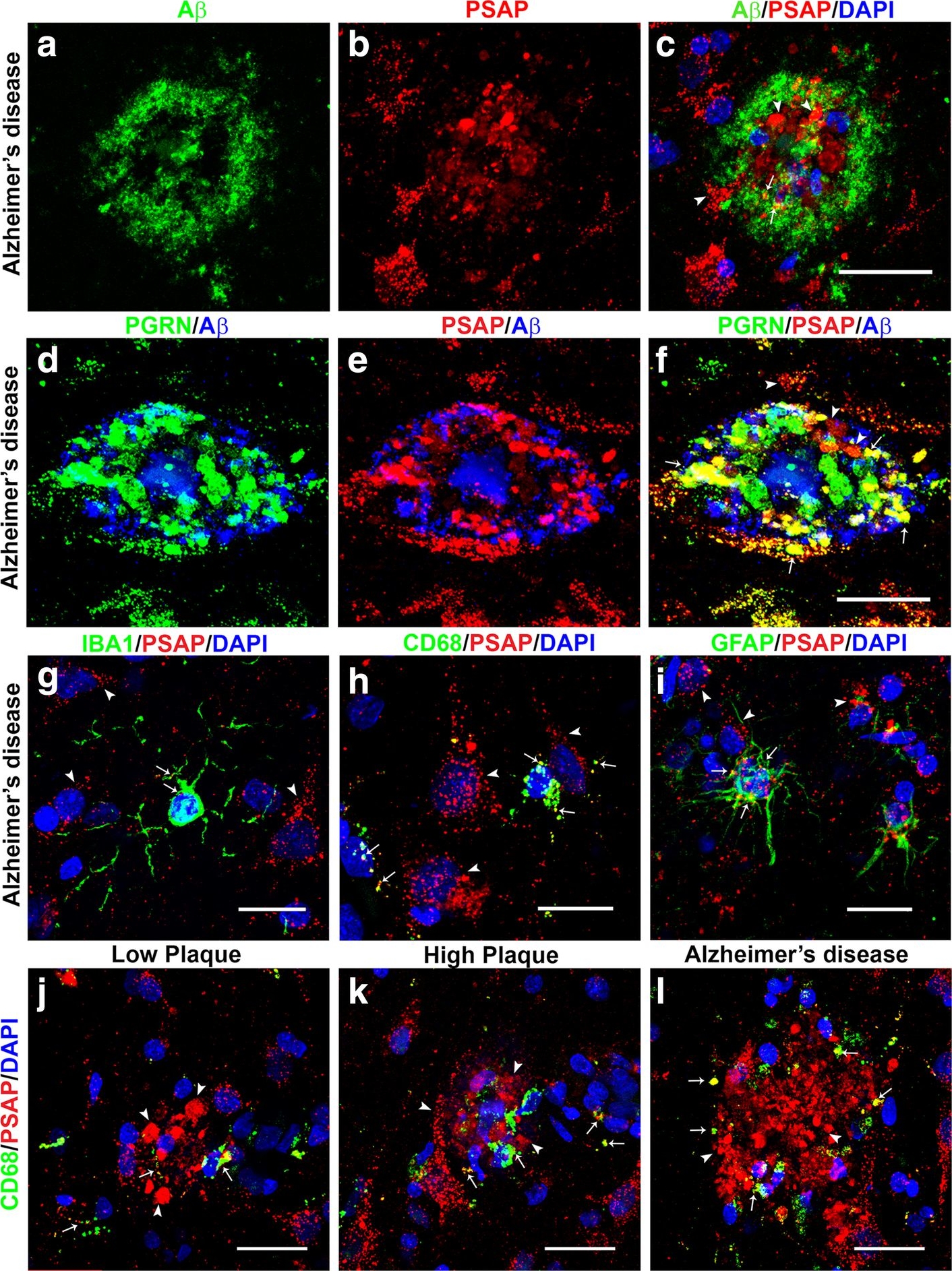 Fig.8.A showing Immunohistochemistry-immunofluorescence in a Homo sapiens (Human) sample from the publication: Characterization of lysosomal proteins Progranulin and Prosaposin and their interactions in Alzheimer's disease and aged brains: increased levels correlate with neuropathology.