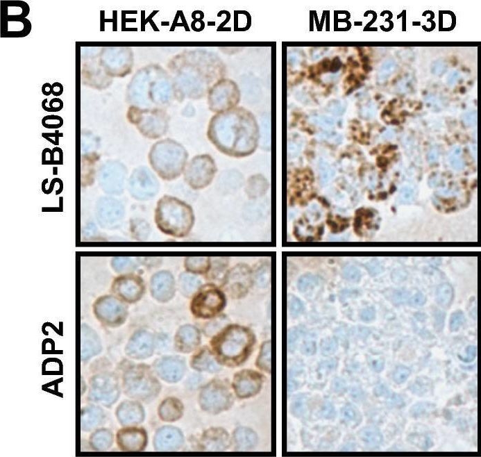 Fig.1.B showing Immunohistochemistry from the publication: ADAM8 is expressed widely in breast cancer and predicts poor outcome in hormone receptor positive, HER-2 negative patients.