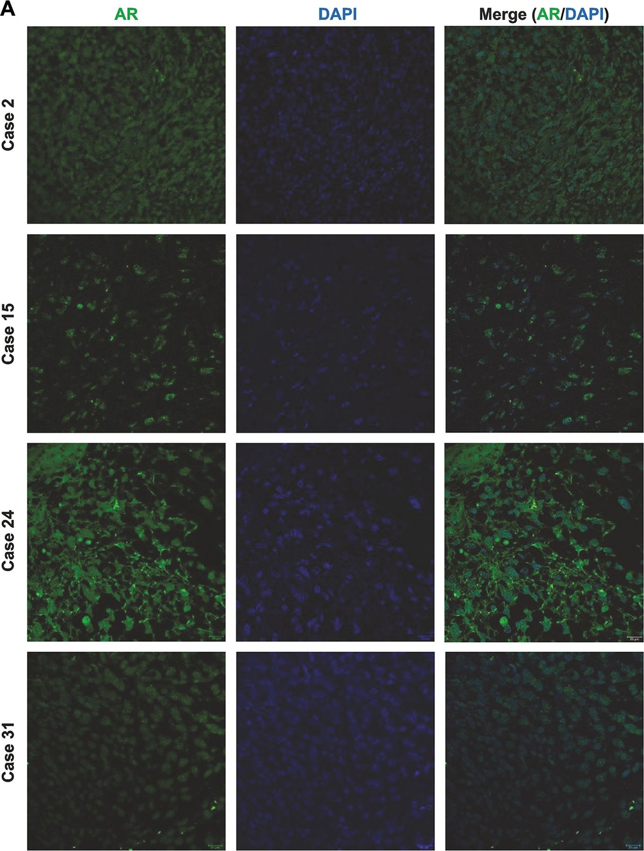 Fig.2.A showing Immunohistochemistry-paraffin-immunofluorescence in a Homo sapiens (Human) sample from the publication: Androgen deficiency is associated with a better prognosis in glioblastoma.