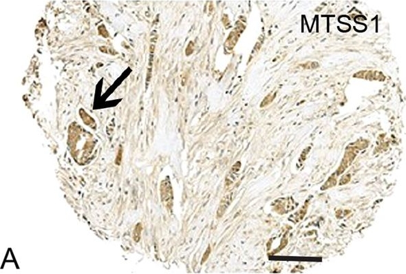 Fig.2.A showing Immunohistochemistry in a Homo sapiens (Human) sample from the publication: MTSS1 and SCAMP1 cooperate to prevent invasion in breast cancer.