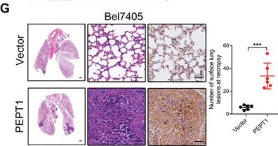 Fig.2.G showing Immunohistochemistry from the publication: Peptide Transporter 1-Mediated Dipeptide Transport Promotes Hepatocellular Carcinoma Metastasis by Activating MAP4K4/G3BP2 Signaling Axis.