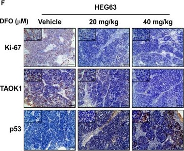 Fig.6.F showing Immunohistochemistry in a Homo sapiens (Human) sample from the publication: Deferasirox Targets TAOK1 to Induce p53-Mediated Apoptosis in Esophageal Squamous Cell Carcinoma.