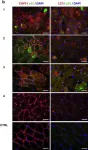 Fig.1.B showing Immunohistochemistry-immunofluorescence in a Homo sapiens (Human) sample from the publication: Autophagy dysregulation in Danon disease.