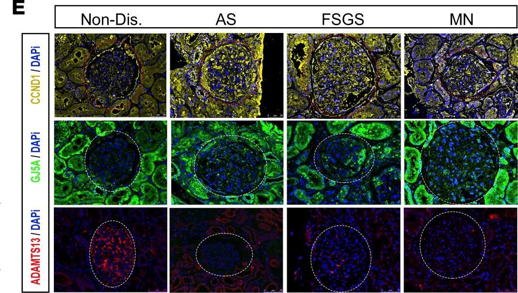 Fig.4.E showing Immunohistochemistry-immunofluorescence in a Homo sapiens (Human) sample from the publication: The spatially resolved transcriptome signatures of glomeruli in chronic kidney disease.