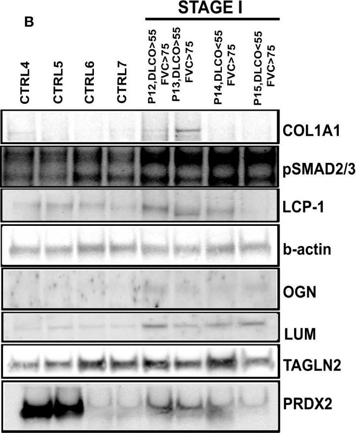 Fig.4.B showing Western Blotting in a Homo sapiens (Human) sample from the publication: Proteomic profiling of formalin-fixed paraffine-embedded tissue reveals key proteins related to lung dysfunction in idiopathic pulmonary fibrosis.