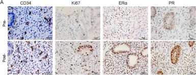 Fig.4.A showing Immunohistochemistry from the publication: Unresponsive thin endometrium caused by Asherman syndrome treated with umbilical cord mesenchymal stem cells on collagen scaffolds: a pilot study.