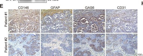 Fig.6.E showing Immunohistochemistry from the publication: CD146+ pericyte-like lung cancer brain metastatic stem cells promote tumor angiogenesis through dual regulatory effects on the VEGF/VEGFR axis.