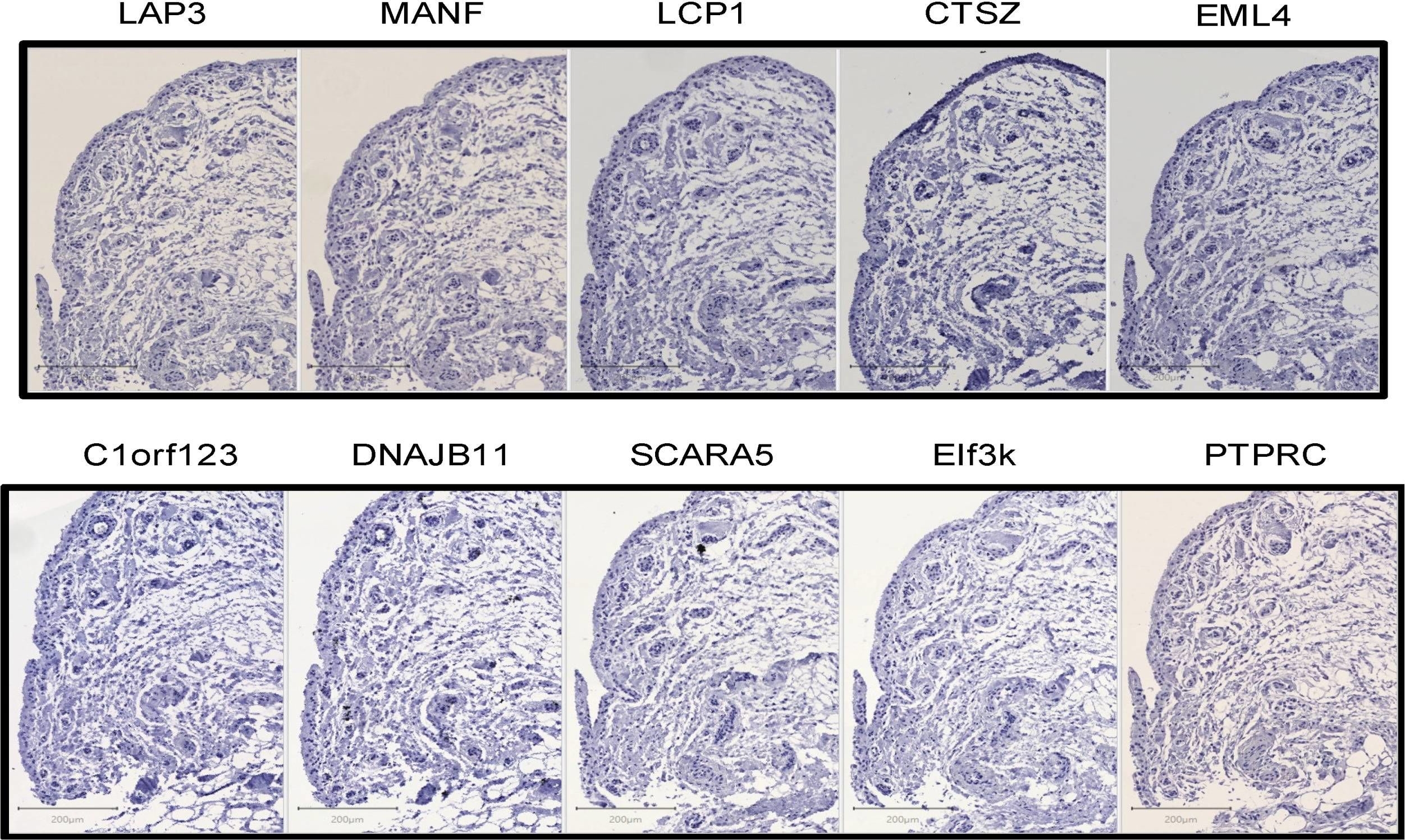 Fig.0.A showing Immunohistochemistry in a Homo sapiens (Human) sample from the publication: New Proteins Contributing to Immune Cell Infiltration and Pannus Formation of Synovial Membrane from Arthritis Diseases.