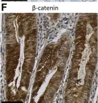 Fig.2.E showing Immunohistochemistry from the publication: Acetaldehyde and defective mismatch repair increase colonic tumours in a Lynch syndrome model with Aldh1b1 inactivation.
