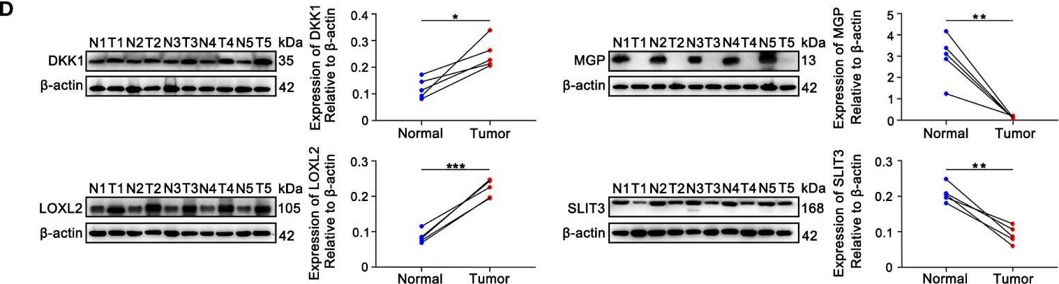 Fig.2.D showing Western Blotting from the publication: A novel epithelial-mesenchymal transition (EMT)-related gene signature of predictive value for the survival outcomes in lung adenocarcinoma.