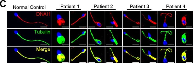 Fig.5.C showing Immunocytochemistry-immunofluorescence in a Homo sapiens (Human) sample from the publication: DNAH3 deficiency causes flagellar inner dynein arm loss and male infertility in humans and mice.