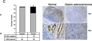Fig.2.C showing Immunohistochemistry from the publication: Highly recurrent CBS epimutations in gastric cancer CpG island methylator phenotypes and inflammation.