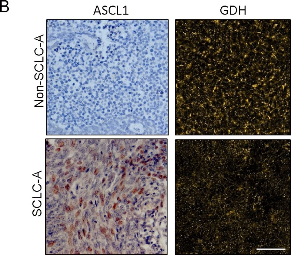 Fig.2.B showing Immunohistochemistry in a Homo sapiens (Human) sample from the publication: Unveiling the powerhouse: ASCL1-driven small cell lung cancer is characterized by higher numbers of mitochondria and enhanced oxidative phosphorylation.