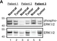 Fig.4.A showing Western Blotting in a Homo sapiens (Human) sample from the publication: An acquired scaffolding function of the DNAJ-PKAc fusion contributes to oncogenic signaling in fibrolamellar carcinoma.