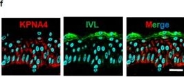 Fig.3.F showing Immunohistochemistry-immunofluorescence from the publication: Disease-specific alteration of karyopherin-α subtype establishes feed-forward oncogenic signaling in head and neck squamous cell carcinoma.