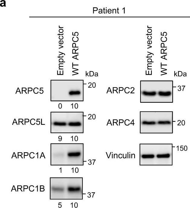 Fig.5.A showing Western Blotting in a Homo sapiens (Human) sample from the publication: Inherited ARPC5 mutations cause an actinopathy impairing cell motility and disrupting cytokine signaling.