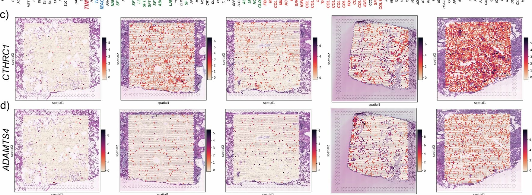 Fig.8.C showing Immunohistochemistry in a Homo sapiens (Human) sample from the publication: Persistence of alveolar fibroblast-derived ADAMTS4+ cells in a preclinical model of delayed pulmonary fibrosis resolution.