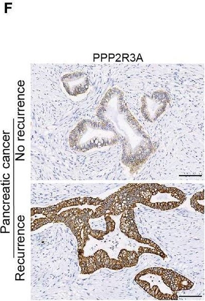 Fig.10.F showing Immunohistochemistry in a Homo sapiens (Human) sample from the publication: Clustering analysis and prognostic model based on PI3K/AKT-related genes in pancreatic cancer.