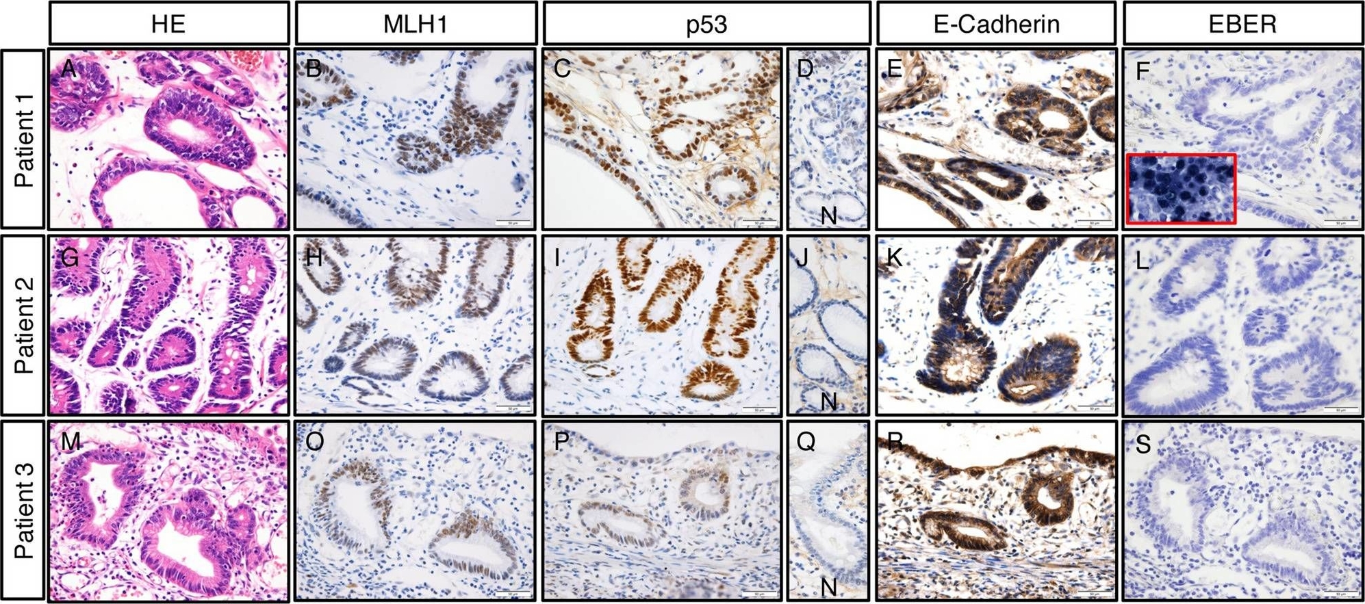 Fig.4.A showing Immunohistochemistry in a Homo sapiens (Human) sample from the publication: Non-Helicobacter pylori Helicobacter (NHPH) positive gastric cancer.