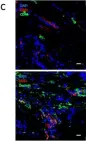 Fig.1.C showing Immunohistochemistry in a Homo sapiens (Human) sample from the publication: Breast cancer cells promote a notch-dependent mesenchymal phenotype in endothelial cells participating to a pro-tumoral niche.