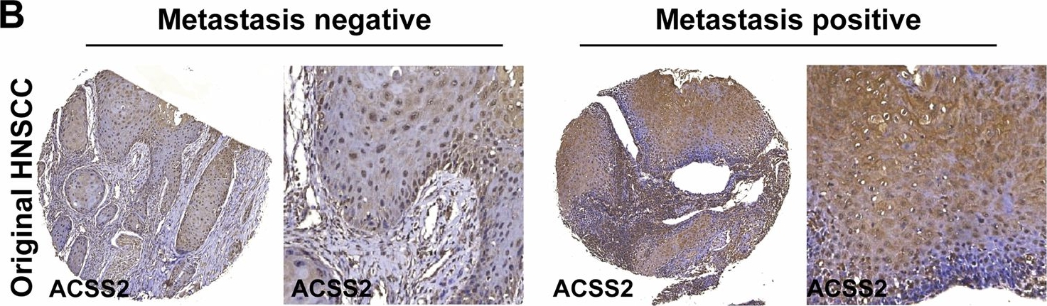 Fig.1.B showing Immunohistochemistry from the publication: ACSS2-TFEB axis acts as a critical regulator of the autophagic machinery in head and neck squamous cell carcinoma.