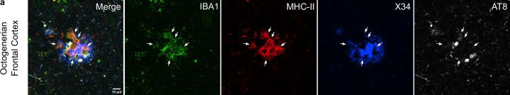 Fig.6.A showing Immunohistochemistry-immunofluorescence from the publication: Human microglial transitions at the Aβ-tau inflection point associate with divergent pathways to dementia and resilience.