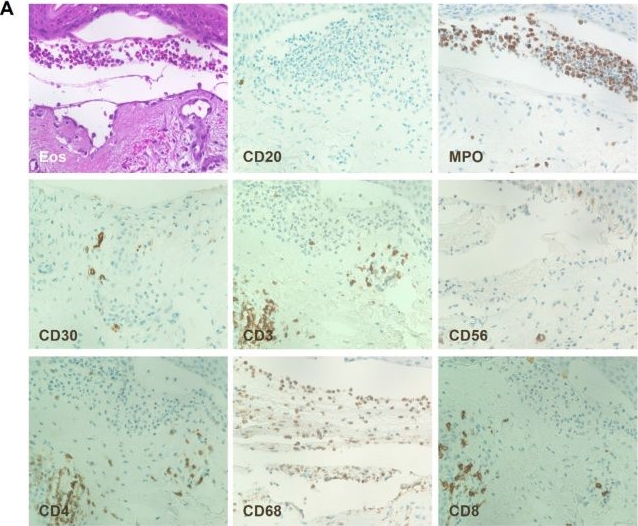 Fig.1.A showing Immunohistochemistry in a Homo sapiens (Human) sample from the publication: Selective Complement Inhibition in Anti-p200 Pemphigoid: Immune Infiltrate Profiles and Therapeutic Implications Compared to Bullous Pemphigoid.