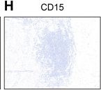 Fig.4.H showing Immunohistochemistry in a Homo sapiens (Human) sample from the publication: Comprehensive analysis based on tertiary lymphoid structures and tumor budding predicts survival rates in colorectal cancer patients with synchronous liver metastases.