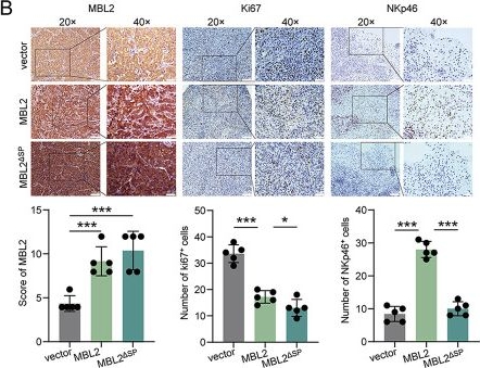 Fig.2.B showing Immunohistochemistry from the publication: Mannose-binding lectin 2 secreted by hepatocellular carcinoma cells recruits and activates natural killer cells to reshape an immune-activated microenvironment.