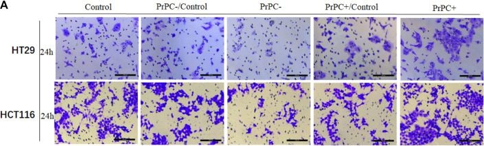 Fig.9.A showing Immunohistochemistry from the publication: PRNP is a pan-cancer prognostic and immunity-related to EMT in colorectal cancer.