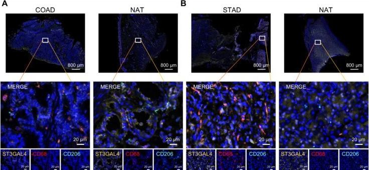 Fig.7.A showing Immunohistochemistry-immunofluorescence from the publication: Systematic Pan-Cancer Characterization of ST3GAL4 Reveals Its Prognostic and Immunologic Associations.