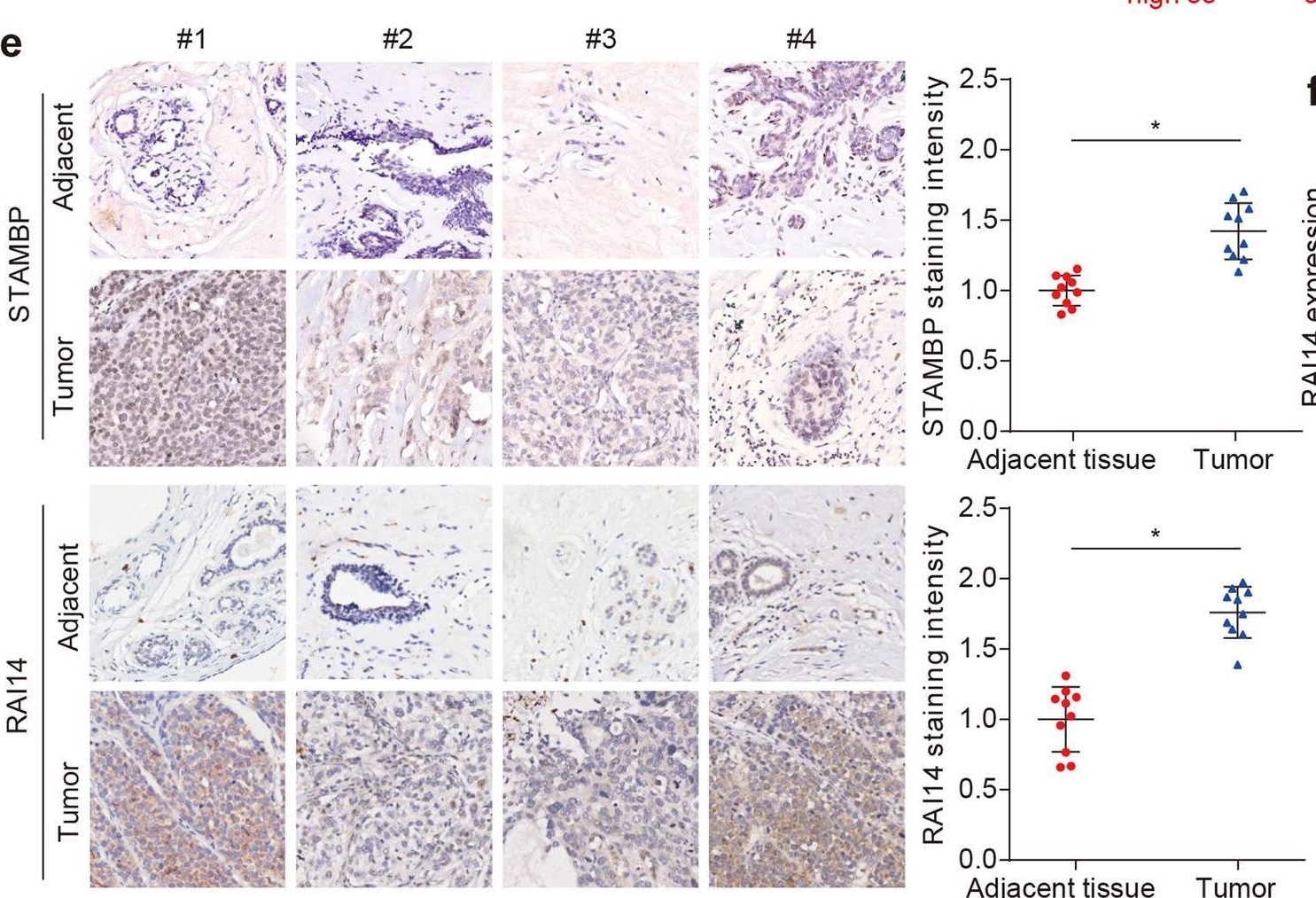 Fig.7.E showing Immunohistochemistry in a Homo sapiens (Human) sample from the publication: The deubiquitinating enzyme STAMBP is a newly discovered driver of triple-negative breast cancer progression that maintains RAI14 protein stability.
