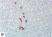 Fig.1.D showing Immunohistochemistry in a Homo sapiens (Human) sample from the publication: Expression of hypoxic marker carbonic anhydrase IX predicts poor prognosis in resectable hepatocellular carcinoma.