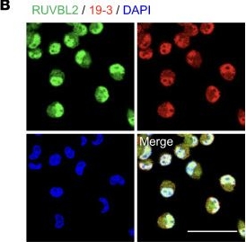 Fig.7.B showing Immunocytochemistry-immunofluorescence in a Homo sapiens (Human) sample from the publication: Plasma cells in human pancreatic ductal adenocarcinoma secrete antibodies against self-antigens.