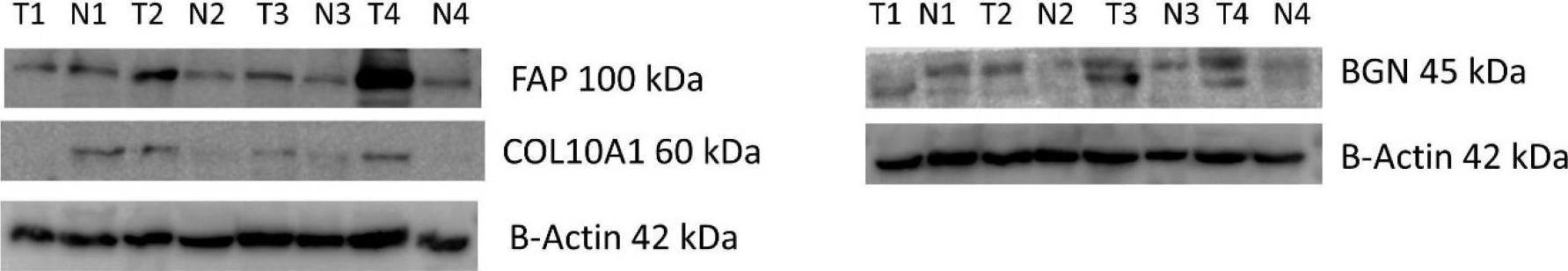 Fig.4.B showing Western Blotting in a Homo sapiens (Human) sample from the publication: Collagen Family and Other Matrix Remodeling Proteins Identified by Bioinformatics Analysis as Hub Genes Involved in Gastric Cancer Progression and Prognosis.