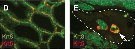 Cooperativity of Rb, Brca1, and p53 in malignant breast cancer evolution.