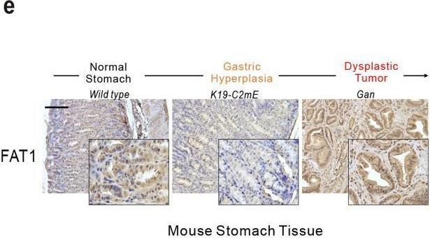 Fig.2.E showing Immunohistochemistry from the publication: Verteporfin inhibits gastric cancer cell growth by suppressing adhesion molecule FAT1.