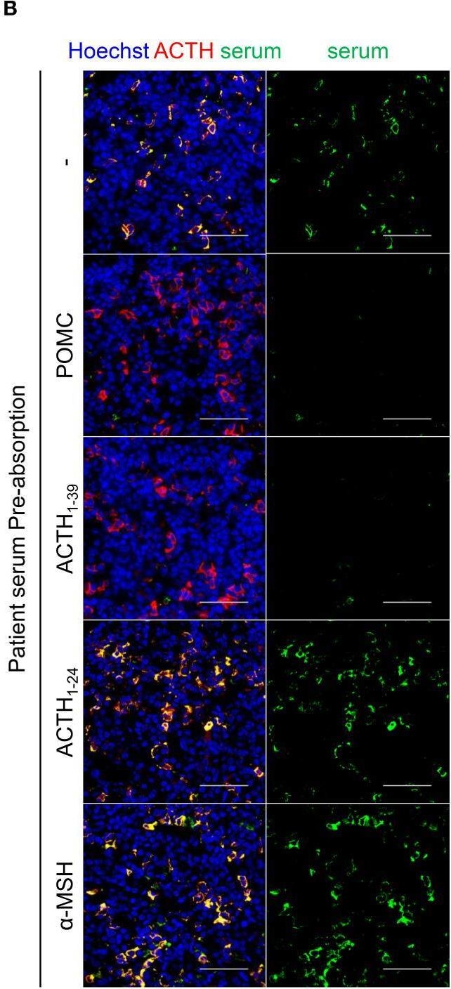Fig.3.B showing Immunohistochemistry-immunofluorescence from the publication: Paraneoplastic isolated adrenocorticotropic hormone deficiency revealed after immune checkpoint inhibitors therapy: new insights into anti-corticotroph antibody.