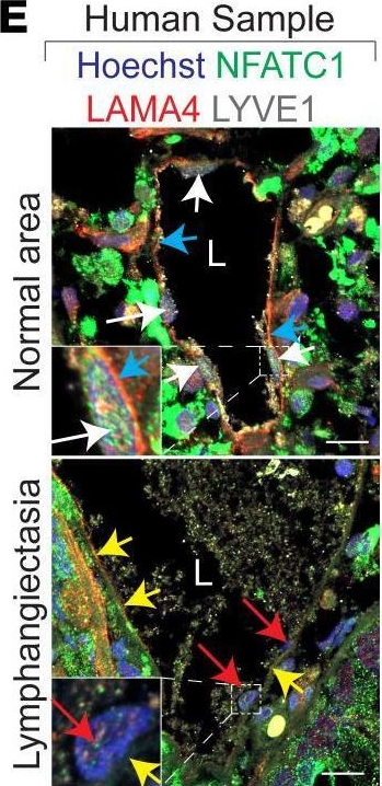 Fig.4.E showing Immunohistochemistry-immunofluorescence in a Homo sapiens (Human) sample from the publication: Pathological MAPK activation-mediated lymphatic basement membrane disruption causes lymphangiectasia that is treatable with ravoxertinib.