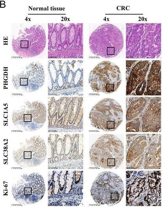 Fig.7.B showing Immunohistochemistry in a Homo sapiens (Human) sample from the publication: Multi-Omics Analysis and Real-World Data Validation of Serine Metabolism-Related Genes in Colorectal Cancer.