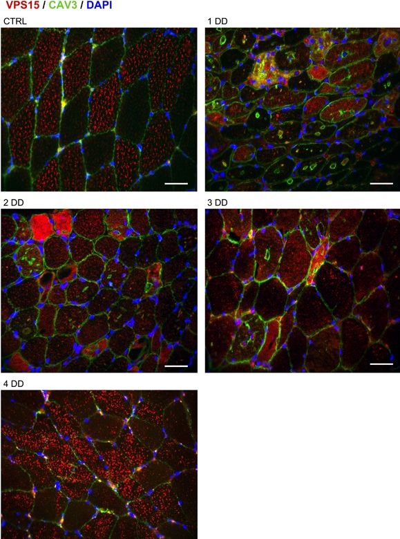 Fig.4.A showing Immunohistochemistry-immunofluorescence in a Homo sapiens (Human) sample from the publication: Autophagy dysregulation in Danon disease.
