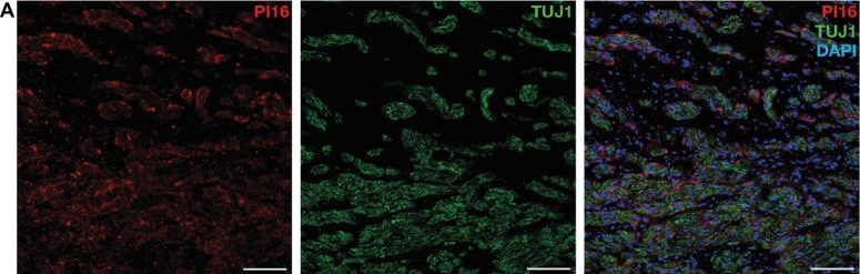 Fig.2.A showing Immunohistochemistry-immunofluorescence from the publication: Spatially resolved single-cell analysis of transcriptomic changes linked with neuropathic pain in human neuromas.