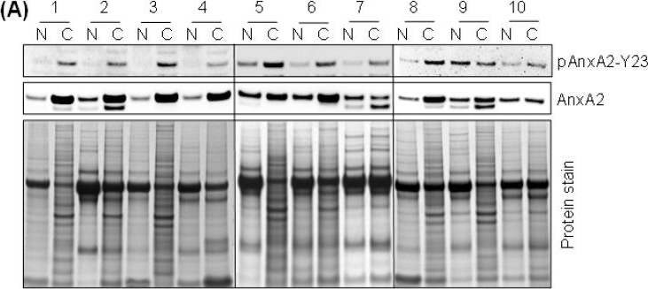 Fig.6.A showing Western Blotting in a Homo sapiens (Human) sample from the publication: Clinical Significance of Annexin A2 Expression in Breast Cancer Patients.