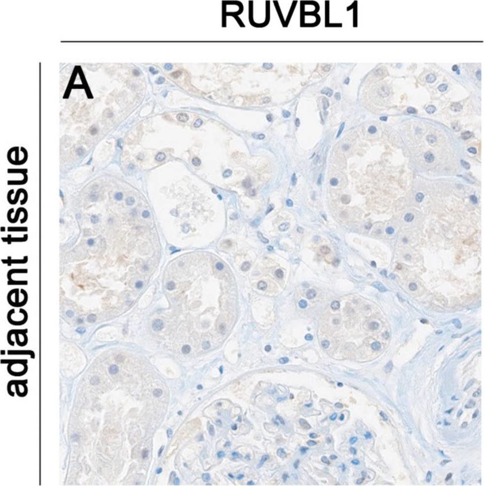 Fig.3.A showing Immunohistochemistry in a Homo sapiens (Human) sample from the publication: RUVBL1 in Clear-Cell Renal Cell Carcinoma: Unraveling Prognostic Significance and Correlation with HIF1A.